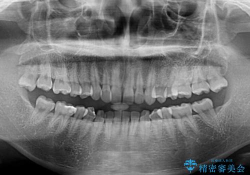【モニター】前歯の歯列不正をワイヤー装置で短期間矯正治療の治療前