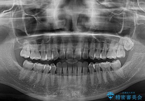 前歯の隙間と上下正中のズレを解消の治療前