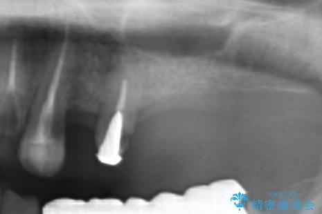 [ 臼歯部インプラント治療 ]ボロボロになった歯を治療したいの治療前