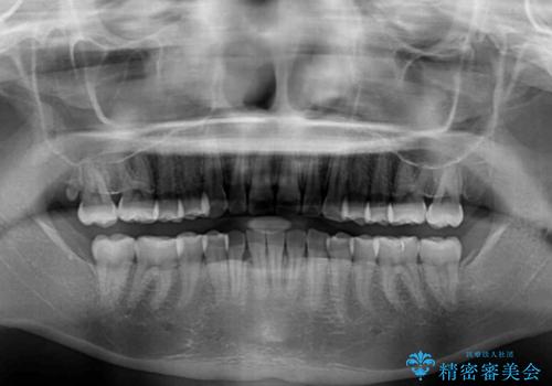 【モニター】前歯のデコボコを目立たないワイヤー装置で短期間矯正治療の治療後