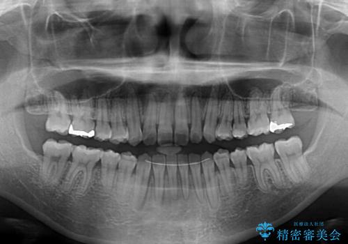 舌突出癖で口元が開いてしまう 舌トレーニングを行ったインビザライン矯正の治療後