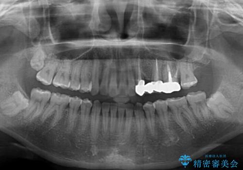 捻れた前歯と銀歯のブリッジを治したい ワイヤー矯正とオールセラミックブリッジの治療後