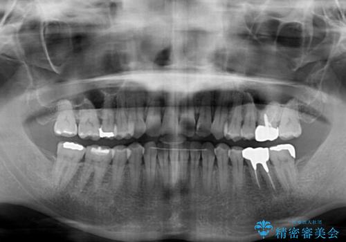 リスク回避 ワイヤー矯正を併用したインビザライン矯正治療の治療後