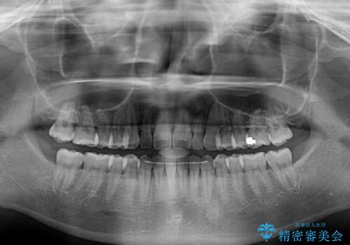 すきっ歯とオープンバイトをインビザラインで改善の治療後