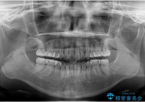 【モニター】八重歯を抜歯矯正でスッキリした口元にの治療後