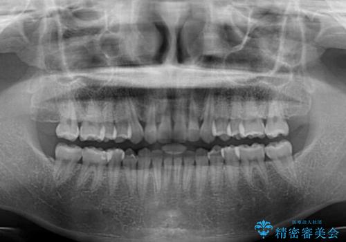 【モニター】前歯の歯列不正をワイヤー装置で短期間矯正治療の治療後