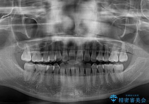 前歯の隙間と上下正中のズレを解消の治療後