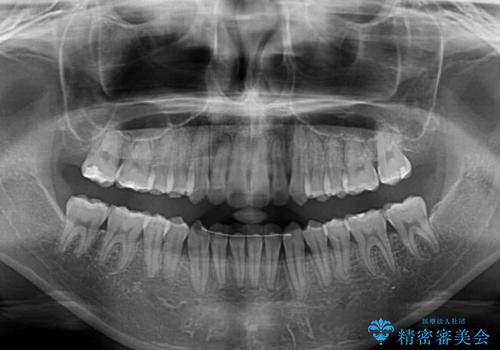 【モニター】前歯の前突感とクロスバイトをインビザラインで改善の治療後