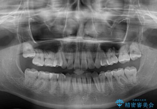 上顎のみの抜歯矯正 前歯のデコボコを改善するの治療後