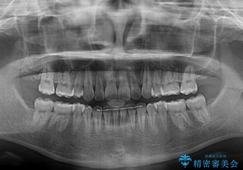 インビザラインが続けられない　ワイヤー矯正での抜歯矯正　その2の治療後