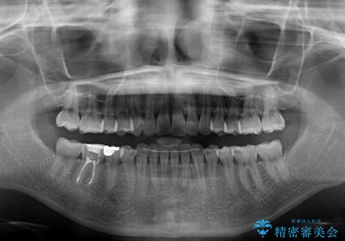 前歯の突出感とデコボコをインビザライン矯正で改善の治療後