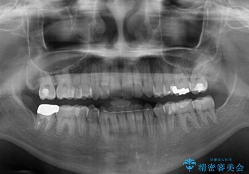 オープンバイトによる見た目を治したい インビザラインでの矯正治療の治療後