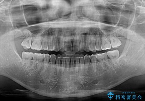 カリエールディスタライザーを併用した、咬み合わせ改善のインビザライン矯正の治療後