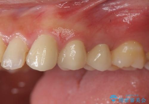 挺出小矯正を行った縁下カリエス治療の症例 治療後