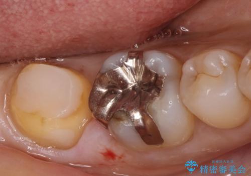 【フルジルコニアクラウン】他院で治療したクラウンが外れたの治療中