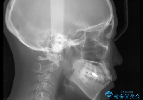 歯ぐき、骨が薄い方のマウスピース矯正治療 非抜歯でもIPR(歯を削る処置)で口元に変化をの治療前