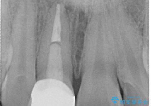 変色した前歯　根の治療とセラミックで白い歯にの治療後