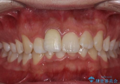 変色した前歯　根の治療とセラミックで白い歯にの症例 治療後