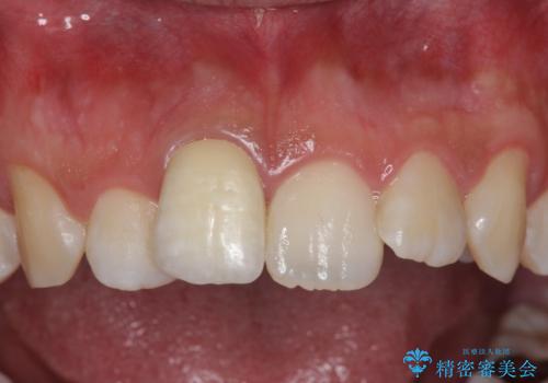 変色した前歯　根の治療とセラミックで白い歯にの治療後