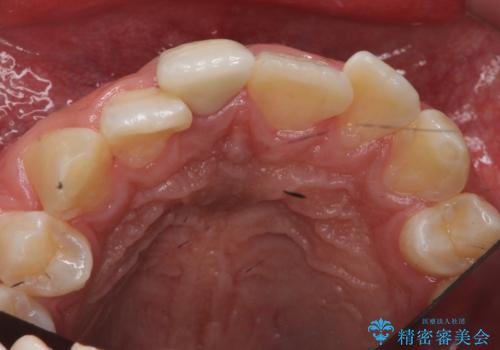 変色した前歯 根の治療とセラミックで白い歯にの治療後