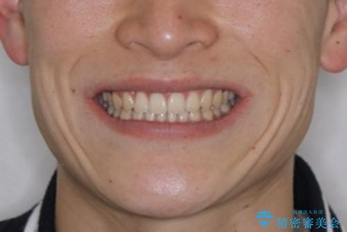 すきっ歯が気になる:見た目も噛み合わせもインビザラインでまとめて治すの治療後(顔貌)