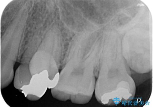銀歯と歯の形が気になる　セラミックの治療前