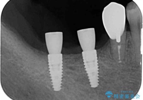 骨の造成を同時に行うインプラント治療の治療中