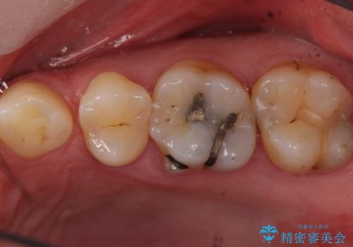 ものが詰まるから、治療してほしい セラミック治療の治療前