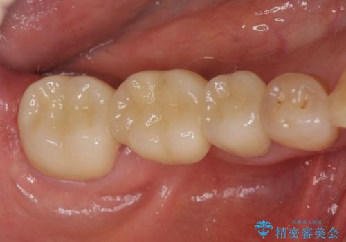 分岐部 Ⅲ 度病変による抜歯　小矯正後のブリッジ治療の治療後