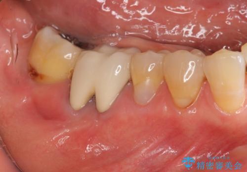 分岐部 Ⅲ 度病変による抜歯　小矯正後のブリッジ治療の症例 治療前