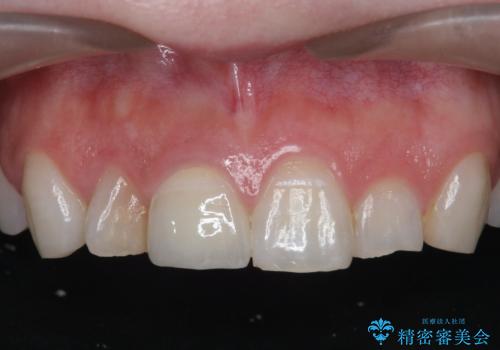 前歯の変色　セラミッククラウンによる審美性の回復の症例 治療後