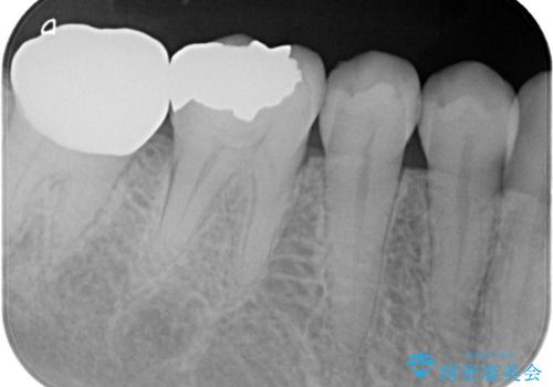 【フルジルコニアクラウン】他院で治療したクラウンが外れたの治療後