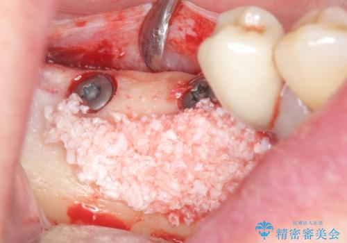 骨の造成を同時に行うインプラント治療の治療前