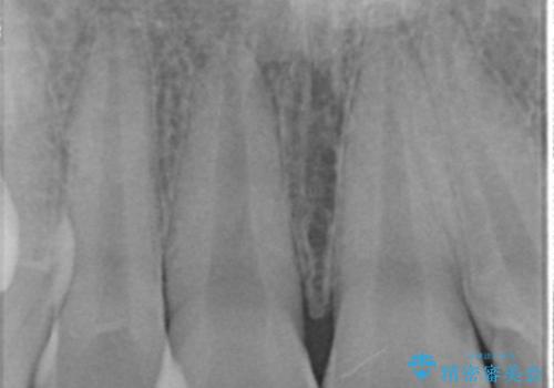 変色した前歯　根の治療とセラミックで白い歯にの治療前
