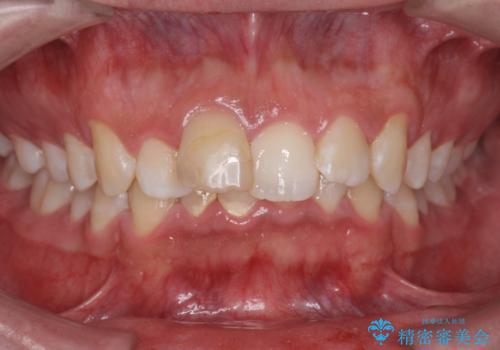 変色した前歯　根の治療とセラミックで白い歯にの症例 治療前