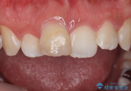 変色した前歯　根の治療とセラミックで白い歯にの治療前