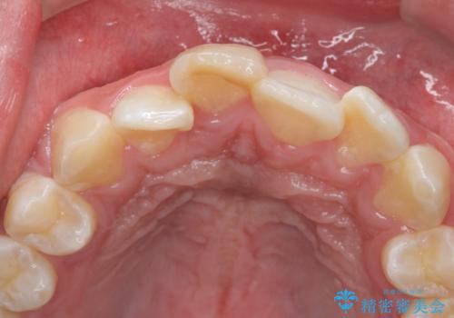 変色した前歯 根の治療とセラミックで白い歯にの治療前