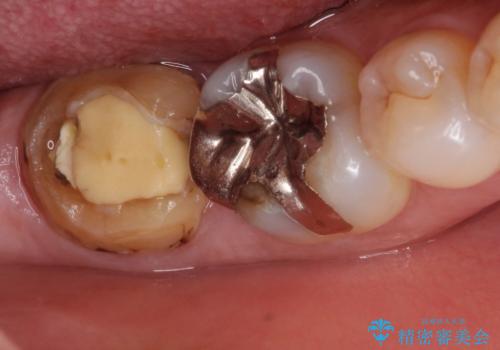 【フルジルコニアクラウン】他院で治療したクラウンが外れたの治療前