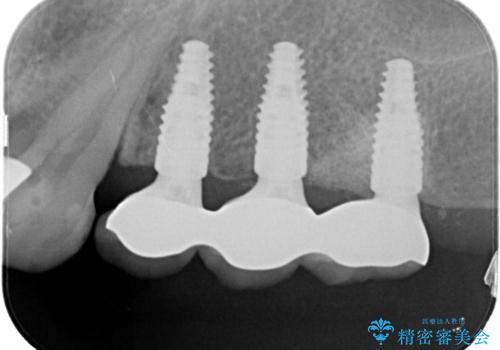 【インプラント】奥歯に歯を入れたいの治療後