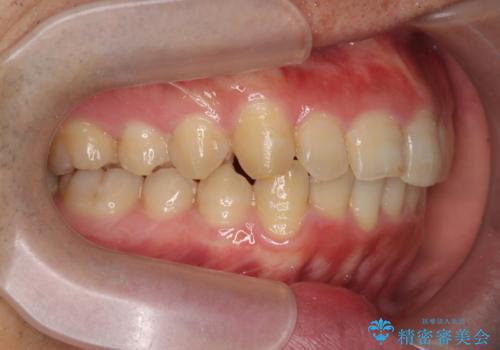 ガタつきの大きい前歯 インビザラインによるマウスピース矯正治療の治療後