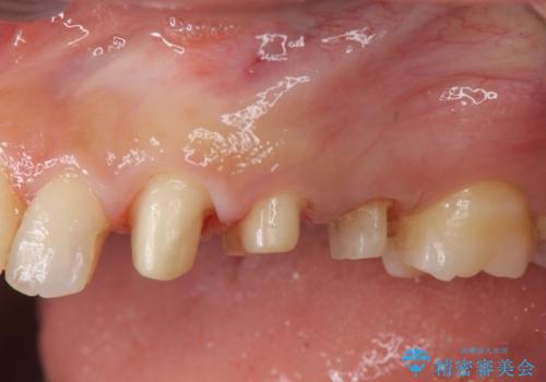 挺出小矯正を行った縁下カリエス治療の治療中