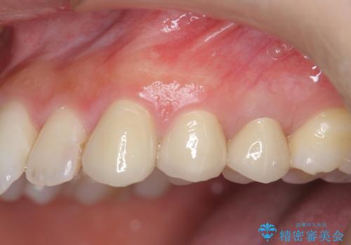 挺出小矯正を行った縁下カリエス治療の治療後