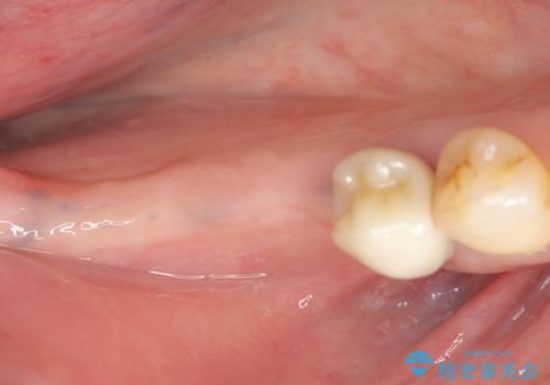 骨の造成を同時に行うインプラント治療の治療前
