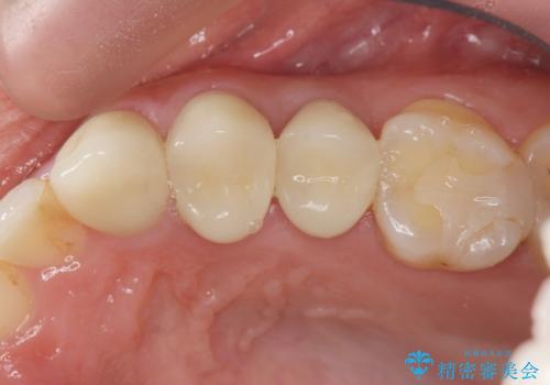 挺出小矯正を行った縁下カリエス治療の治療後