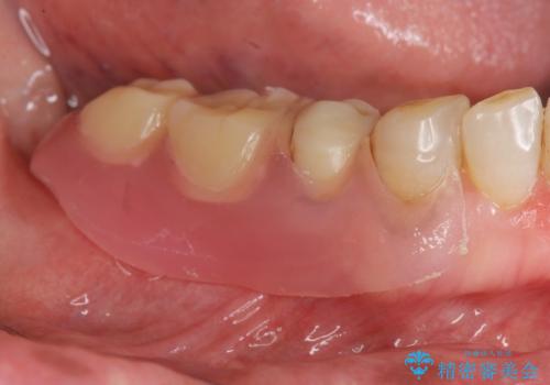 [ ノンクラスプデンチャー ]  目立たない入れ歯の作製の症例 治療後