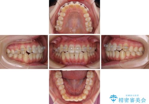 【モニター】前歯の前突感とクロスバイトをインビザラインで改善の治療中