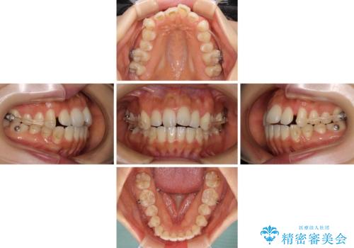 カリエールディスタライザーを併用した、咬み合わせ改善のインビザライン矯正の治療中