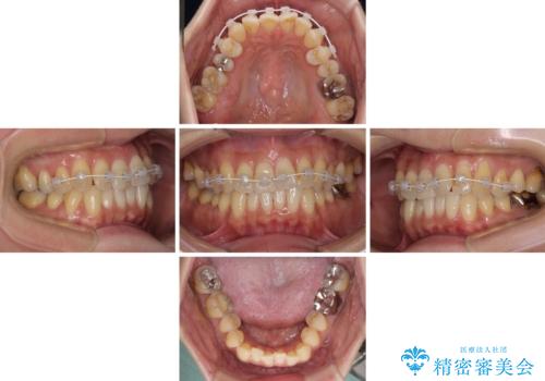 リスク回避 ワイヤー矯正を併用したインビザライン矯正治療の治療中