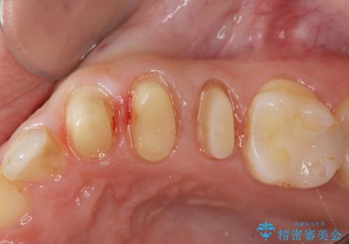 挺出小矯正を行った縁下カリエス治療の治療中