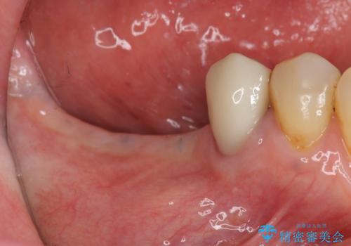骨の造成を同時に行うインプラント治療の治療中